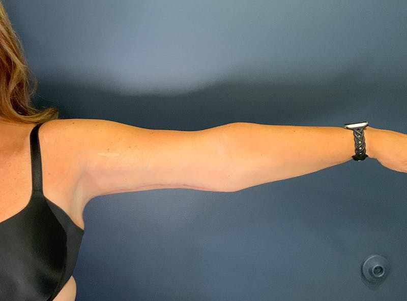 Liposuction Before & After Gallery - Patient 153853 - Image 2