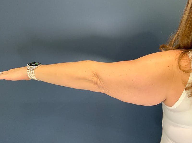 Liposuction Before & After Gallery - Patient 153853 - Image 3