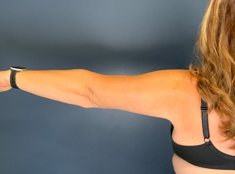 Liposuction Before & After Gallery - Patient 153853 - Image 4