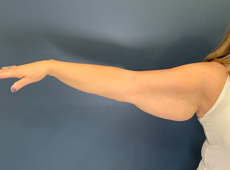 Liposuction Before & After Gallery - Patient 153853 - Image 5