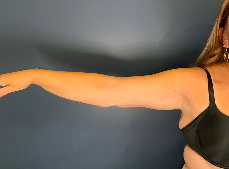 Liposuction Before & After Gallery - Patient 153853 - Image 6