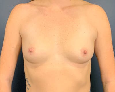 Breast Augmentation Before & After Gallery - Patient 414906 - Image 1