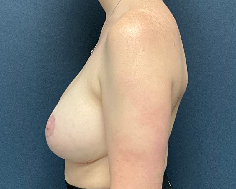 Breast Augmentation Before & After Gallery - Patient 248688 - Image 10