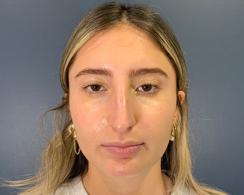 Rhinoplasty Before & After Gallery - Patient 301323 - Image 1