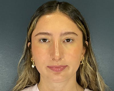 Rhinoplasty Before & After Gallery - Patient 301323 - Image 2