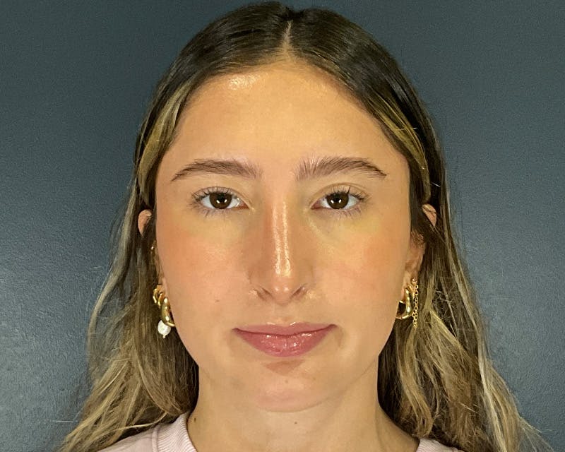 Rhinoplasty Before & After Gallery - Patient 301323 - Image 2