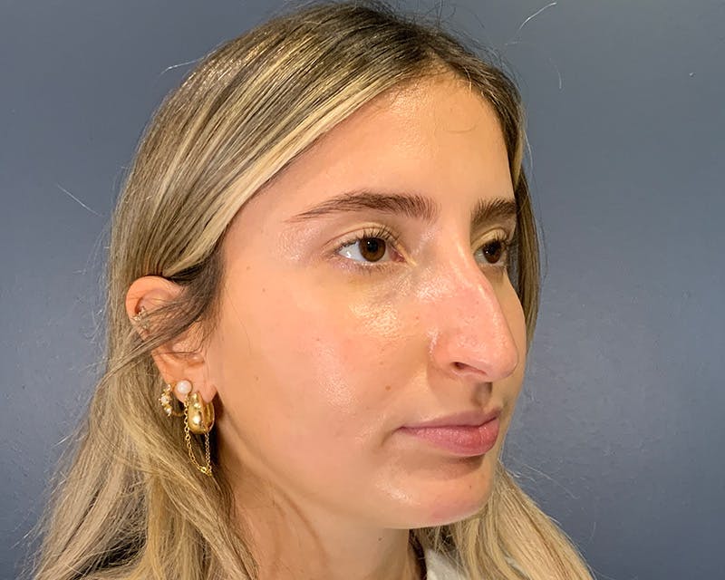 Rhinoplasty Before & After Gallery - Patient 301323 - Image 3