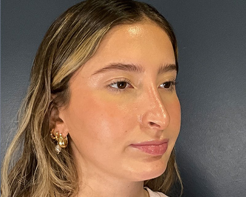 Rhinoplasty Before & After Gallery - Patient 301323 - Image 4