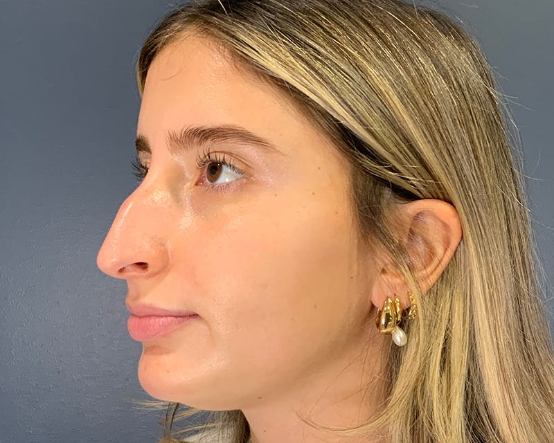 Rhinoplasty Before & After Gallery - Patient 301323 - Image 5