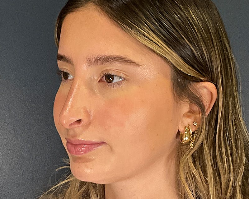 Rhinoplasty Before & After Gallery - Patient 301323 - Image 6