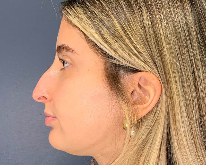 Rhinoplasty Before & After Gallery - Patient 301323 - Image 7
