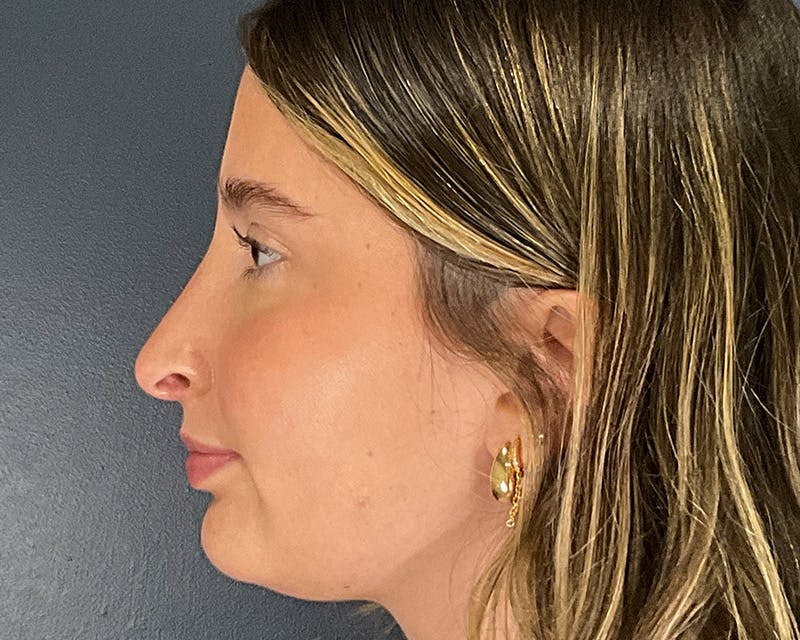 Rhinoplasty Before & After Gallery - Patient 301323 - Image 8