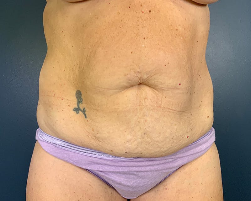 Tummy Tuck Before & After Gallery - Patient 211378 - Image 1