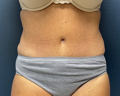 Liposuction Before & After Gallery - Patient 284435 - Image 2