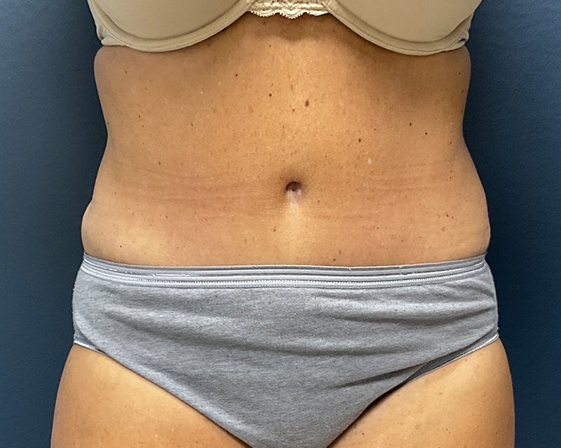 Tummy Tuck Before & After Gallery - Patient 211378 - Image 2