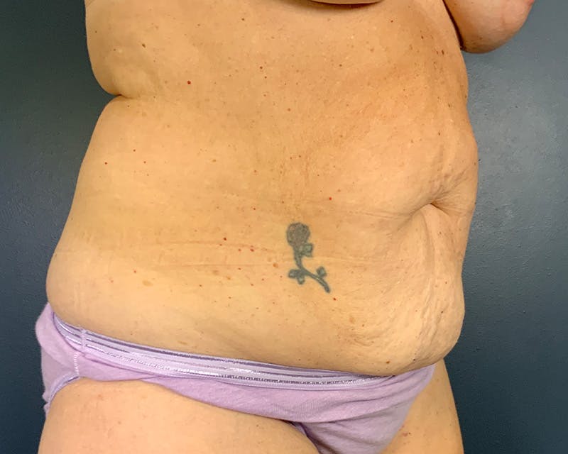 Tummy Tuck Before & After Gallery - Patient 211378 - Image 3