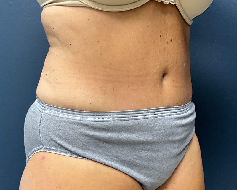 Tummy Tuck Before & After Gallery - Patient 211378 - Image 4