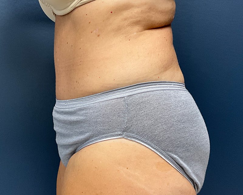 Tummy Tuck Before & After Gallery - Patient 211378 - Image 6