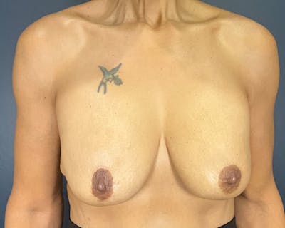 Breast Lift Before & After Gallery - Patient 219415 - Image 1