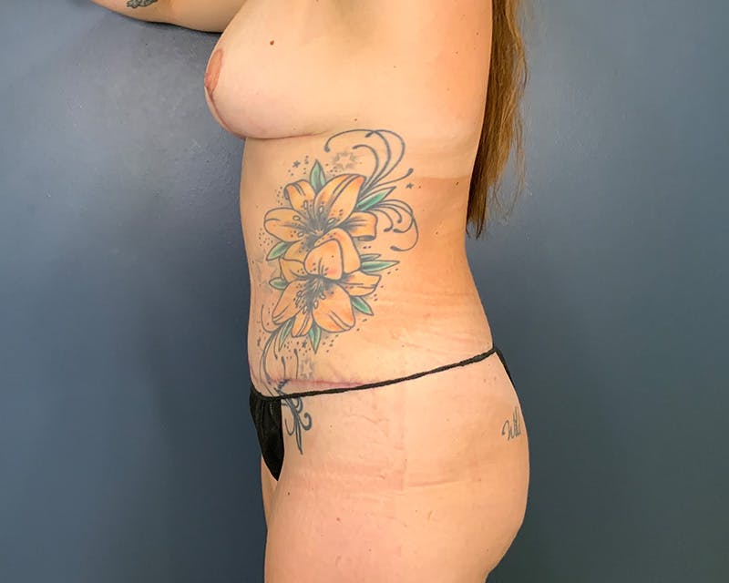Breast Reduction Before & After Gallery - Patient 155607 - Image 8