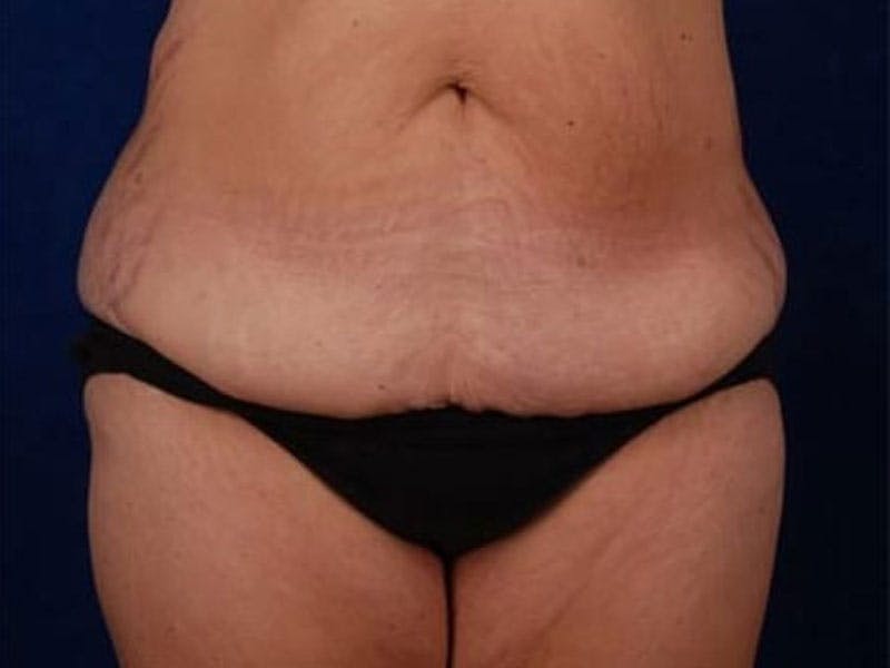 Body Lift Before & After Gallery - Patient 154091 - Image 1