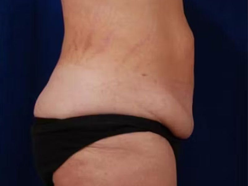 Body Lift Before & After Gallery - Patient 154091 - Image 4