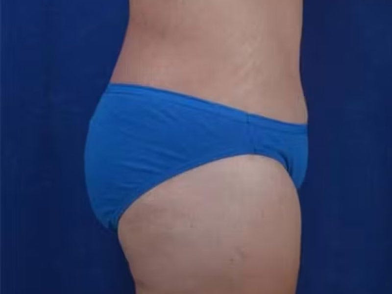 Body Lift Before & After Gallery - Patient 154091 - Image 3