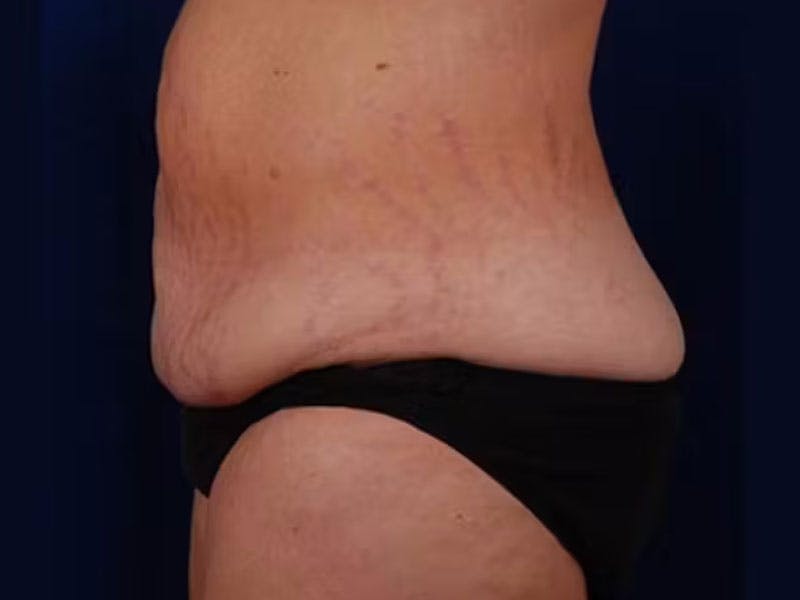 Body Lift Before & After Gallery - Patient 154091 - Image 6
