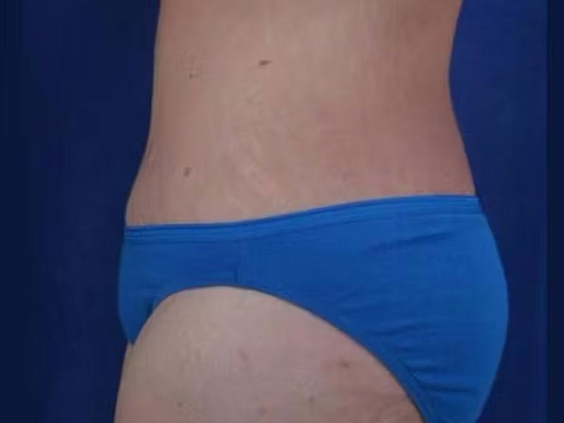 Body Lift Before & After Gallery - Patient 154091 - Image 5