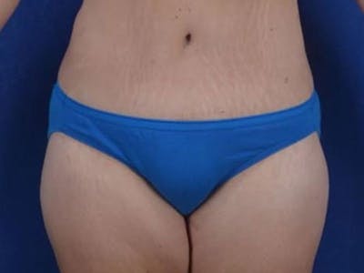 Body Lift Before & After Gallery - Patient 154091 - Image 2