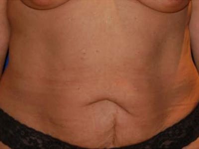 Body Lift Before & After Gallery - Patient 930742 - Image 1