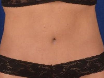 Body Lift Before & After Gallery - Patient 930742 - Image 2