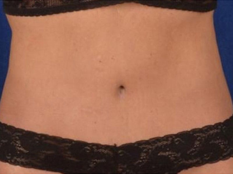 Body Lift Before & After Gallery - Patient 930742 - Image 2