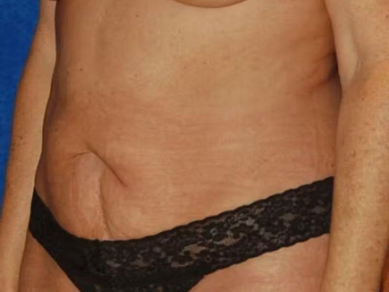 Body Lift Before & After Gallery - Patient 930742 - Image 3