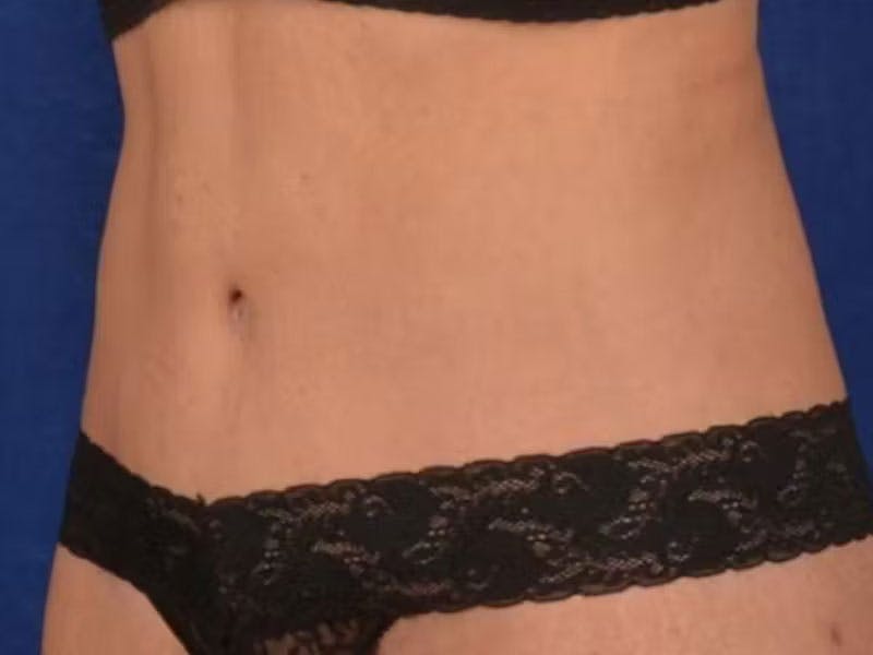 Body Lift Before & After Gallery - Patient 930742 - Image 4