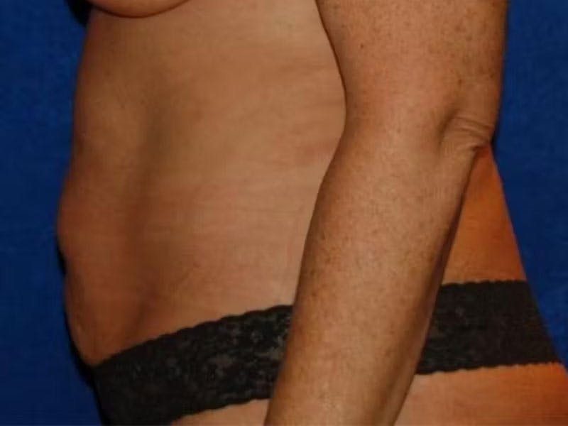 Body Lift Before & After Gallery - Patient 930742 - Image 5