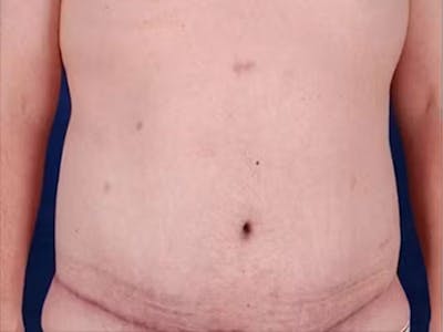 Body Lift Before & After Gallery - Patient 272663 - Image 2