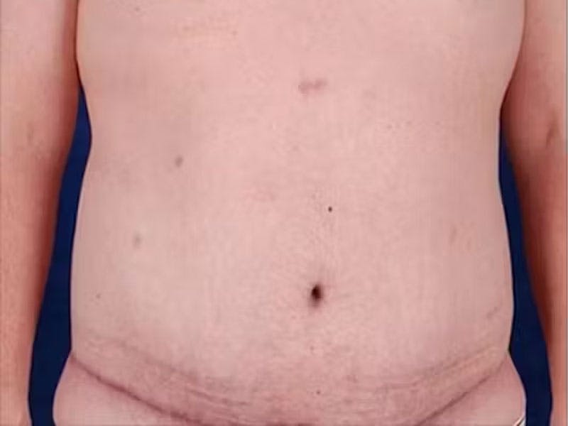 Body Lift Before & After Gallery - Patient 272663 - Image 2