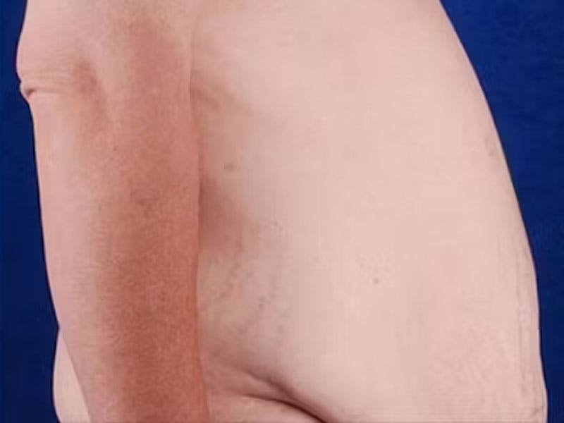Body Lift Before & After Gallery - Patient 272663 - Image 3