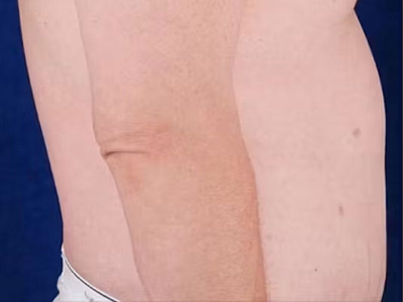 Body Lift Before & After Gallery - Patient 272663 - Image 4