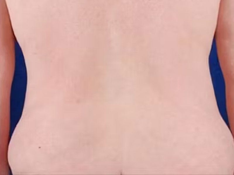 Body Lift Before & After Gallery - Patient 272663 - Image 5