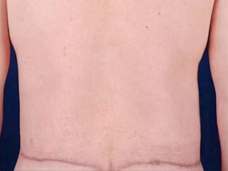 Body Lift Before & After Gallery - Patient 272663 - Image 6
