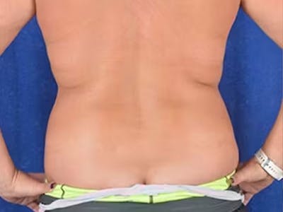 Liposuction Before & After Gallery - Patient 426461 - Image 1