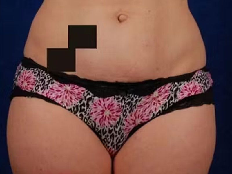 Liposuction Before & After Gallery - Patient 382641 - Image 1