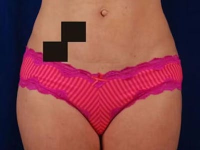 Liposuction Before & After Gallery - Patient 382641 - Image 2