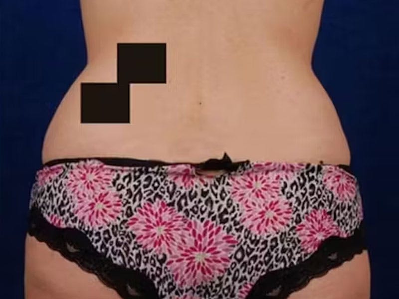 Liposuction Before & After Gallery - Patient 382641 - Image 3