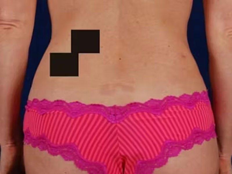 Liposuction Before & After Gallery - Patient 382641 - Image 4