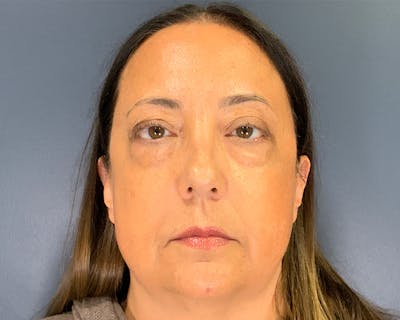 Blepharoplasty Before & After Gallery - Patient 384811 - Image 1