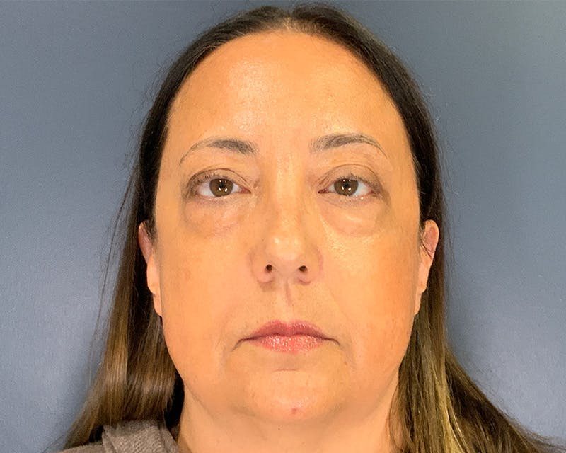 Blepharoplasty Before & After Gallery - Patient 384811 - Image 1