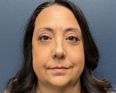 Blepharoplasty Before & After Gallery - Patient 384811 - Image 2